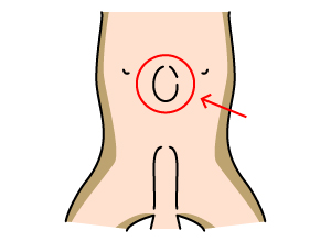 臍ヘルニア（サイへルニア）