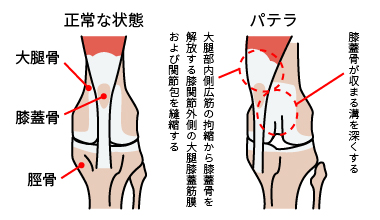 膝蓋骨脱臼（パテラ）